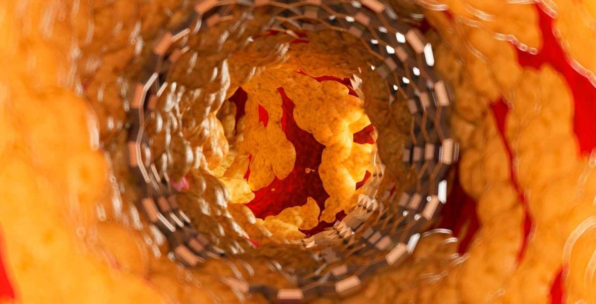 medical implants for the treatment of vascular diseases