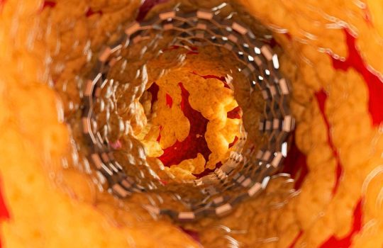 medical implants for the treatment of vascular diseases2