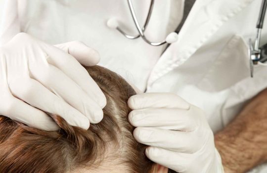 פסוריאזיס בקרקפת2